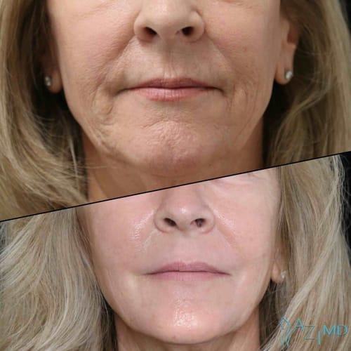 Velora Instant Face Tightener® No-Filter Primer